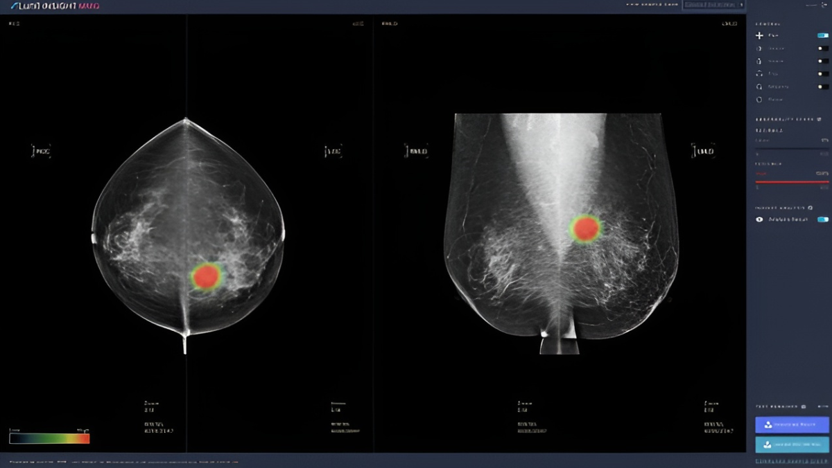 Mammogram scan with AI heatmap marking a region of elevated breast cancer risk.
